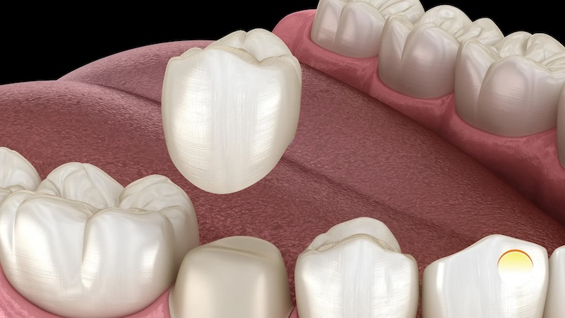 Dental Crowns 1