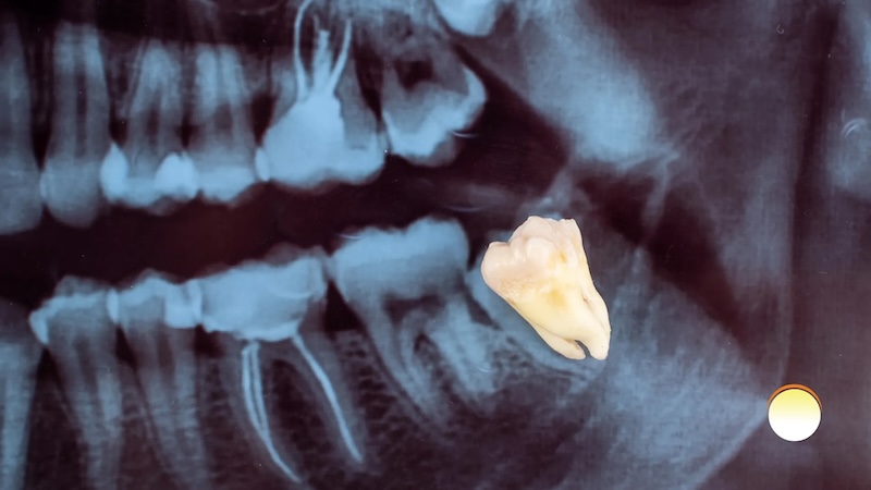 Wisdom Teeth 1